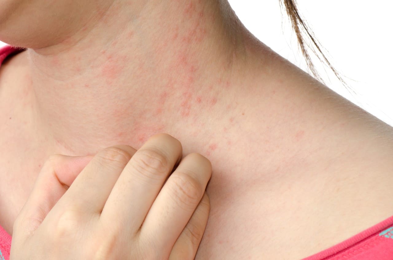 En este momento estás viendo ¿Qué es la Dermatitis Atópica y cómo tratarla?