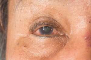 Lee más sobre el artículo Glaucoma, el ladrón silencioso de la visión: ¿Cómo detectarla a tiempo?